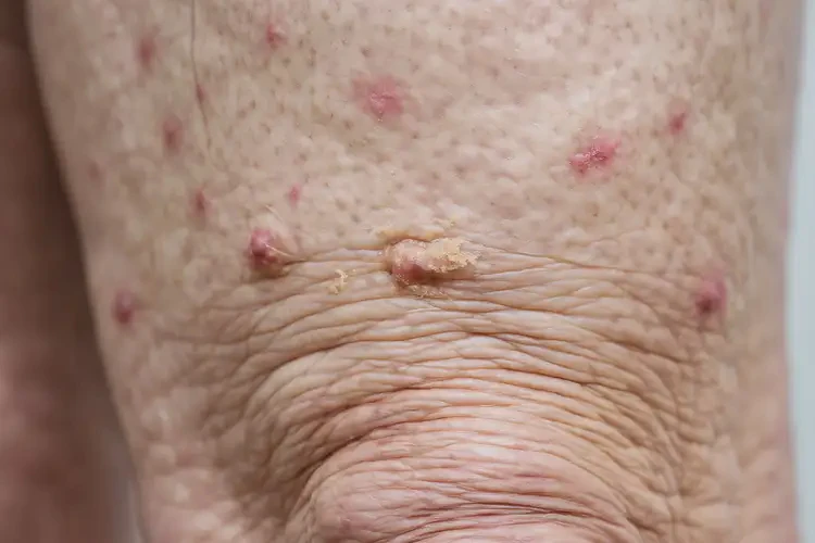 高齡老人大腿上有濕疹不管它會(huì)自己自愈嗎(圖4)