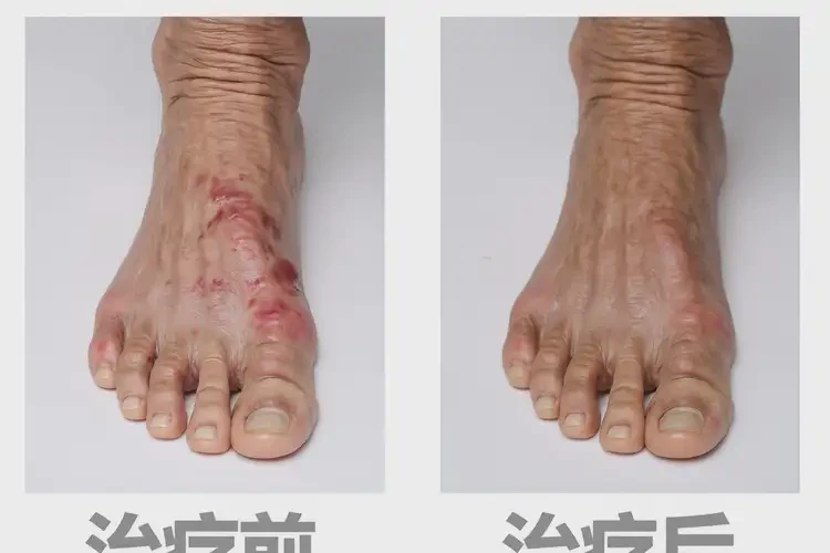 老人腳上容易長濕疹不管它會自己痊愈嗎(圖2)
