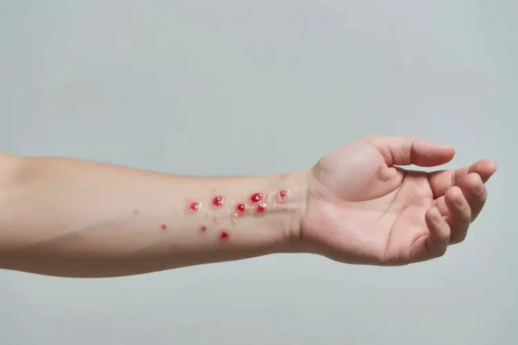 男人手臂容易起濕疹不管它會自己好嗎(圖4)