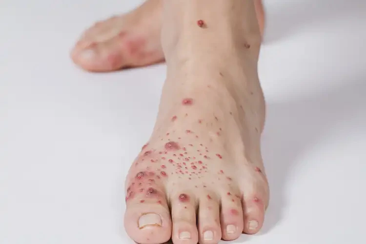 小兒腳上偶爾起濕疹能徹底自愈嗎(圖2)