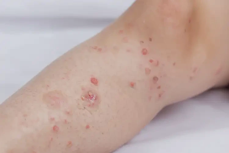 小兒小腿上起濕疹能靠自己自愈嗎(圖3)