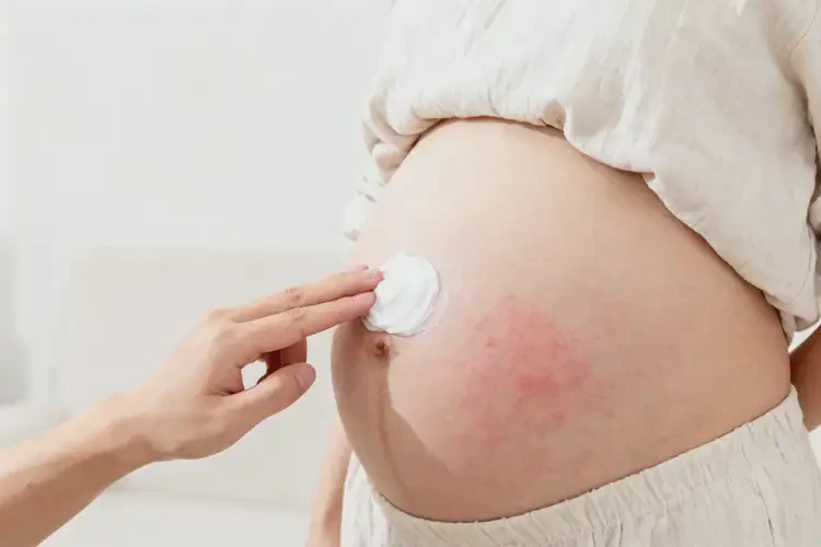 孕妇肚子上出现湿疹不管它会自己好吗(图2)