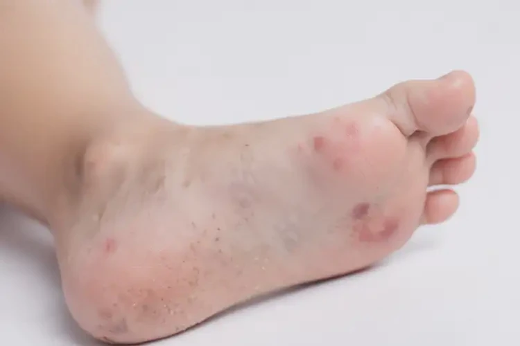 兒童腳上起濕疹能靠自己自愈嗎(圖4)