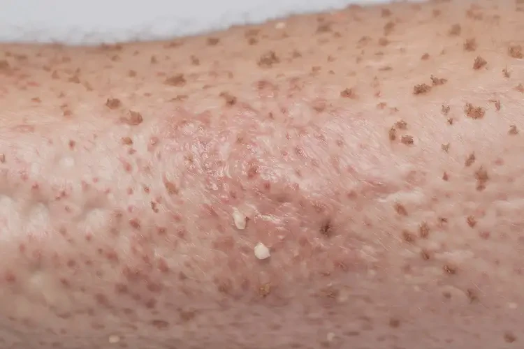 女生手臂上偶爾起濕疹不管它會(huì)自己痊愈嗎(圖3)