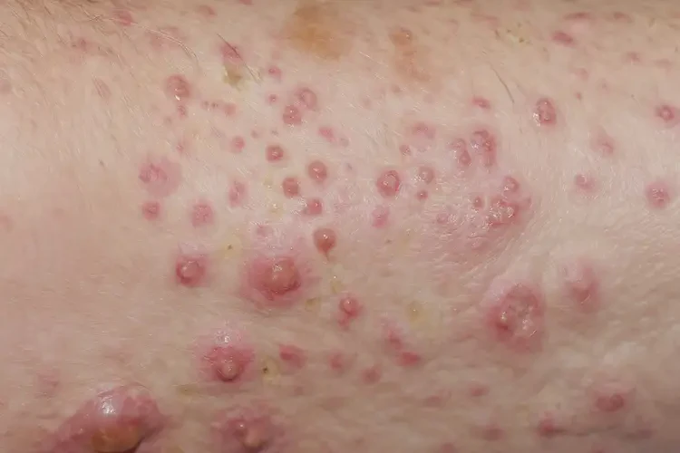 小學(xué)生大腿上經(jīng)常起濕疹不管它會自己痊愈嗎(圖3)