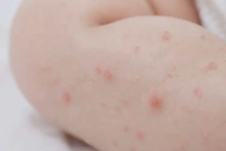 寶寶小腿上容易起濕疹不管它會(huì)自己好嗎(圖4)