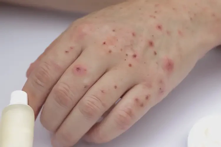 大學(xué)生手上起濕疹可以徹底自愈嗎(圖3)