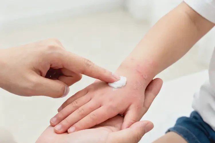 少兒手上有濕疹不管它會(huì)自己好嗎(圖2)