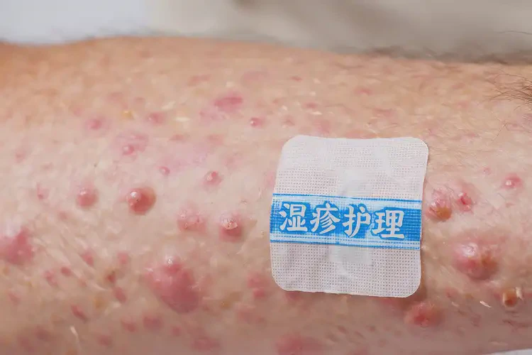 女生全身長(zhǎng)濕疹不管它會(huì)自己自愈嗎(圖3)