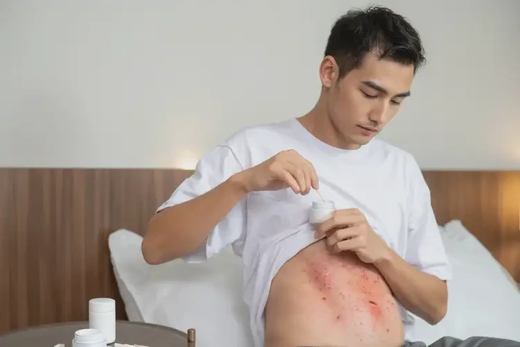 青年人肚子長濕疹能不能徹底自愈(圖3)