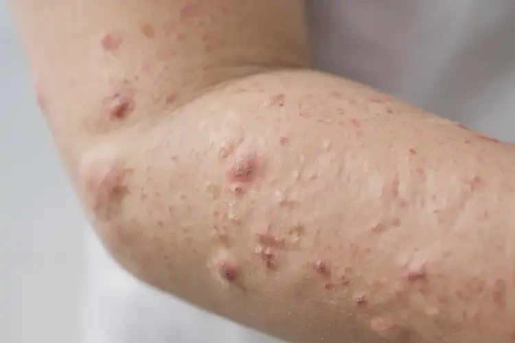 小学生手上有湿疹不管它会自己好吗(图4)