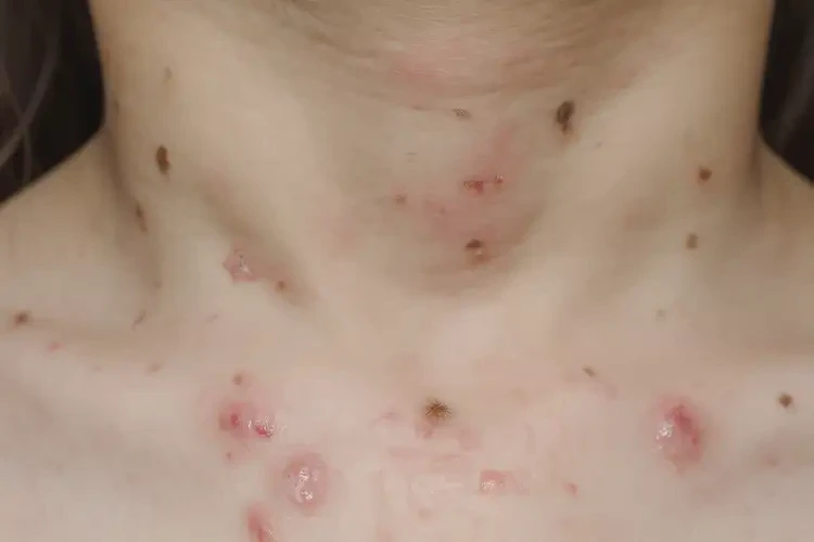 孩子脖子上經(jīng)常長濕疹能夠徹底治愈嗎(圖4)