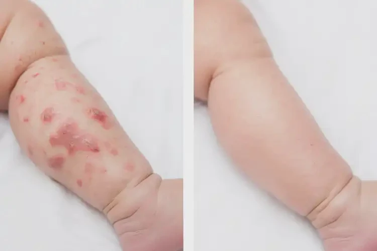 新生儿小腿上经常长湿疹可以彻底自愈吗(图1)