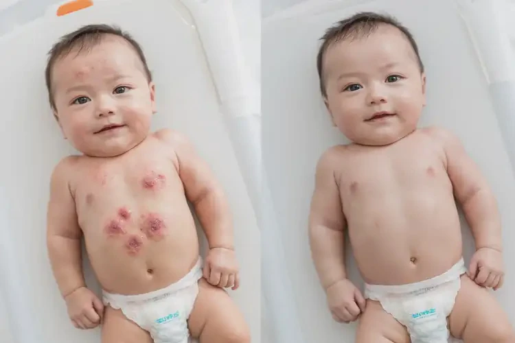 小兒屁股上長濕疹能徹底自愈嗎(圖2)