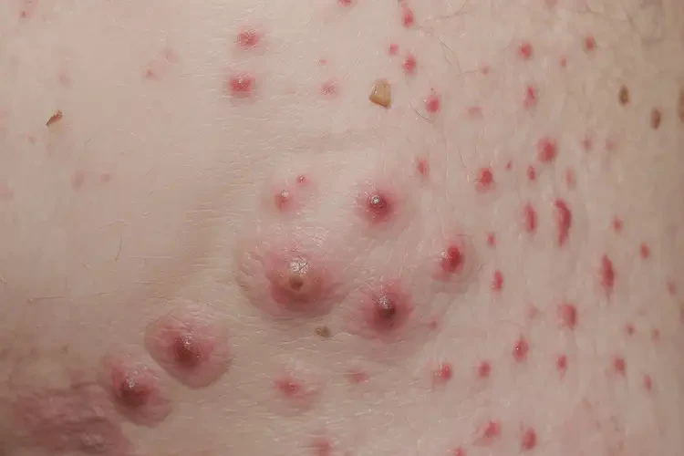 女生肛周長濕疹可不可以徹底自愈(圖4)