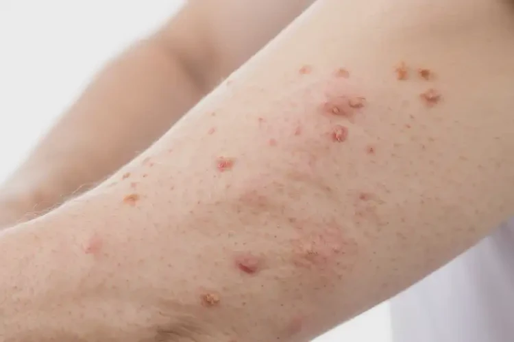 女人手臂上經(jīng)常長(zhǎng)濕疹能不能徹底自愈(圖4)