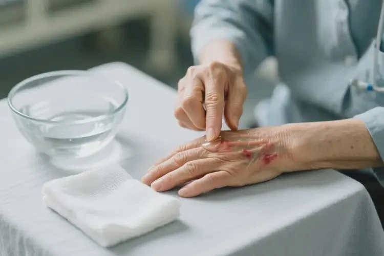 高齡老人手上容易起濕疹能不能根治(圖2)