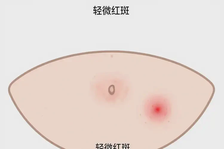 小孩肚子上偶尔长湿疹能靠自己自愈吗(图4)