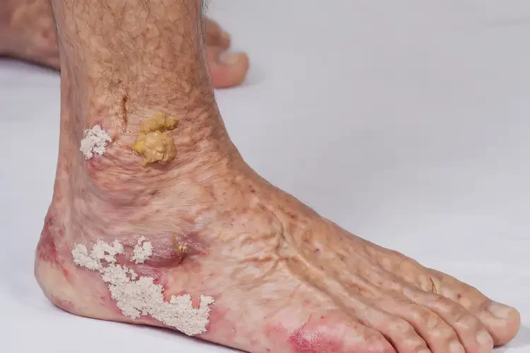 兒童腳上偶爾長(zhǎng)濕疹不管它會(huì)自己自愈嗎(圖2)