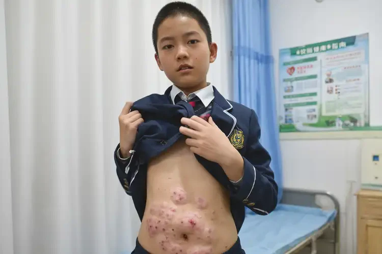 中學(xué)生肚子有濕疹不管它會(huì)自己自愈嗎(圖4)