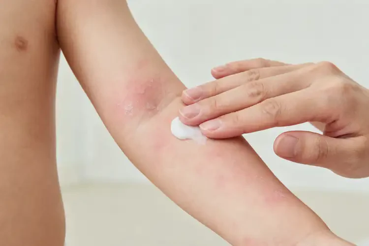 幼儿手臂上有湿疹不管它会自己好吗(图1)