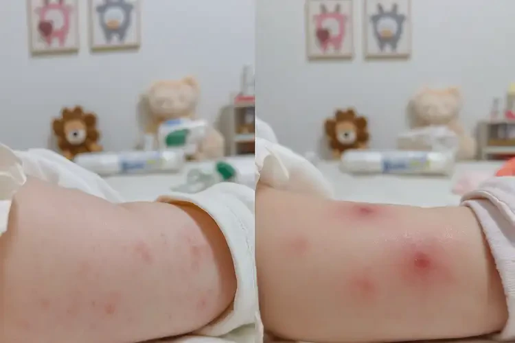 新生兒手臂容易長濕疹能徹底自愈嗎(圖2)