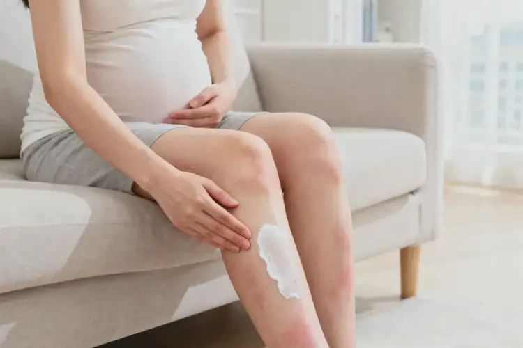 孕婦小腿上容易起濕疹不管它會(huì)自己痊愈嗎(圖2)