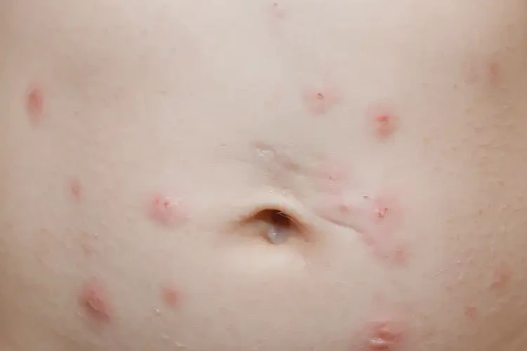 兒童肚子經(jīng)常長濕疹不管它會自己好嗎(圖4)