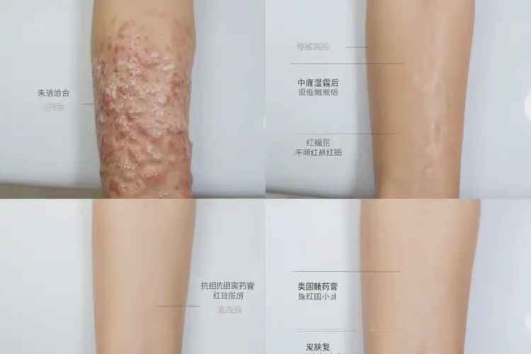 女性手臂上容易起湿疹能靠自己自愈吗(图3)