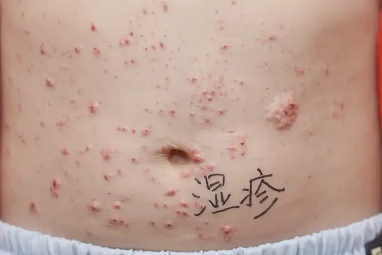 小學(xué)生肚子起濕疹可不可以徹底自愈(圖4)