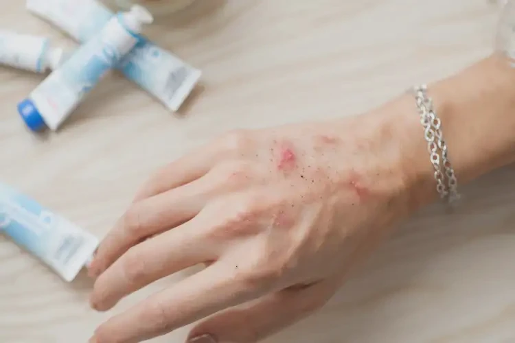 女生手上偶尔长湿疹不管它会自己好吗(图4)
