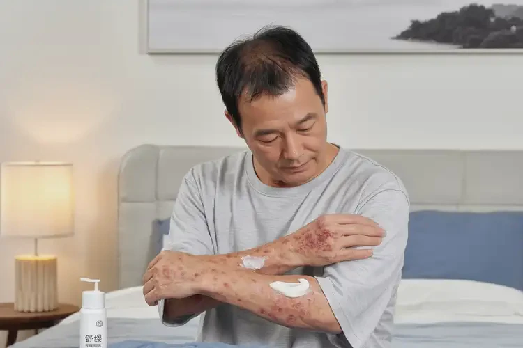 男人手臂有濕疹能不能徹底自愈(圖2)