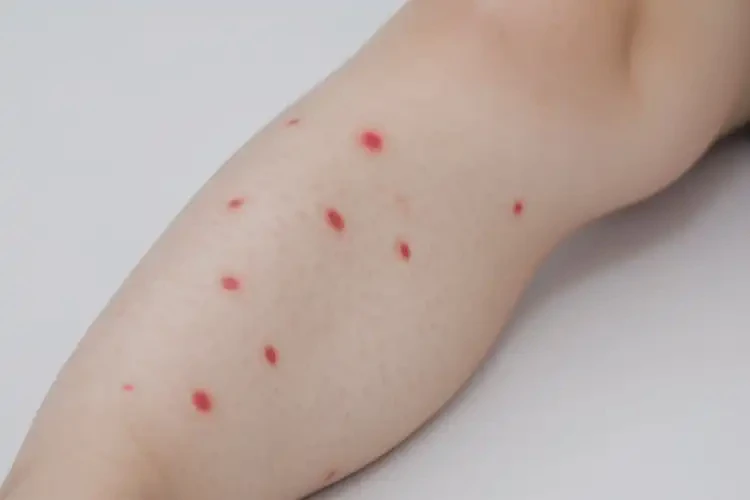 少兒屁股容易長濕疹可不可以徹底自愈(圖3)