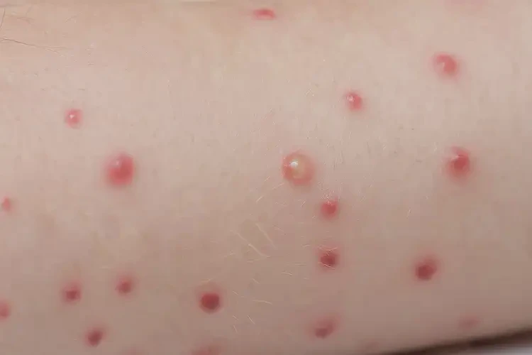 少兒屁股容易長濕疹可不可以徹底自愈(圖4)