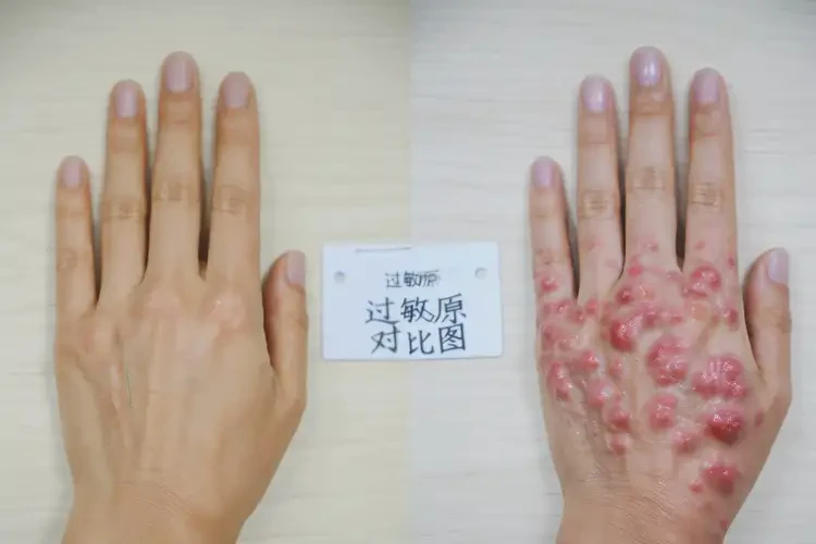 哺乳期妈妈手上偶尔长湿疹可不可以彻底自愈(图2)