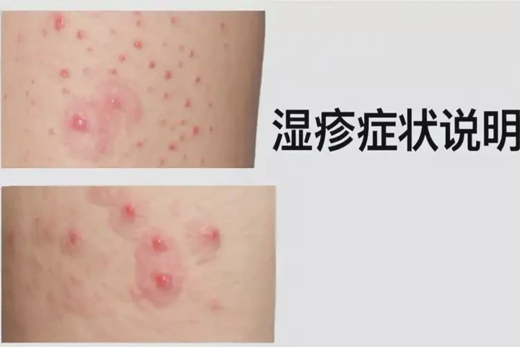 男人四肢有濕疹能徹底自愈嗎(圖3)