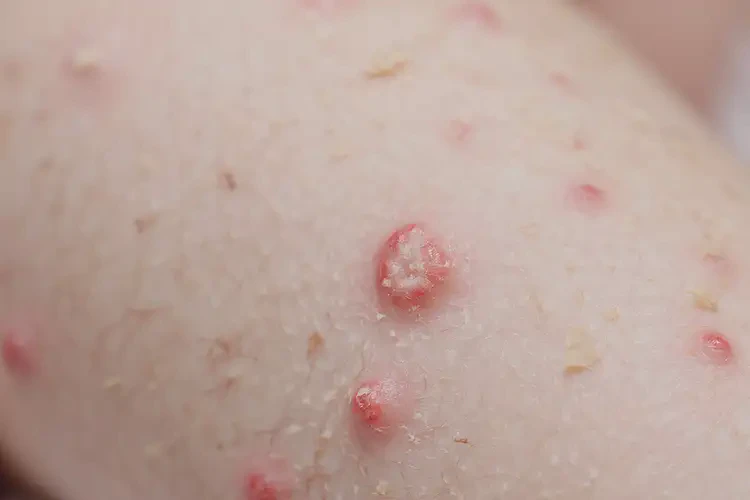 幼儿四肢有湿疹能彻底自愈吗(图4)