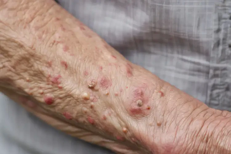 高齡老人手臂出現(xiàn)濕疹不管它會自己好嗎(圖4)
