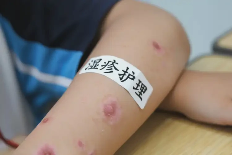 小學(xué)生手臂出濕疹能徹底自愈嗎(圖4)