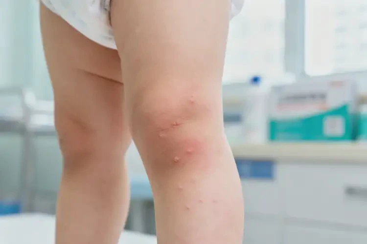 小兒大腿上容易長濕疹不管它會自己自愈嗎(圖2)