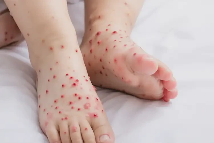 小兒腳上偶爾起濕疹能徹底自愈嗎(圖3)