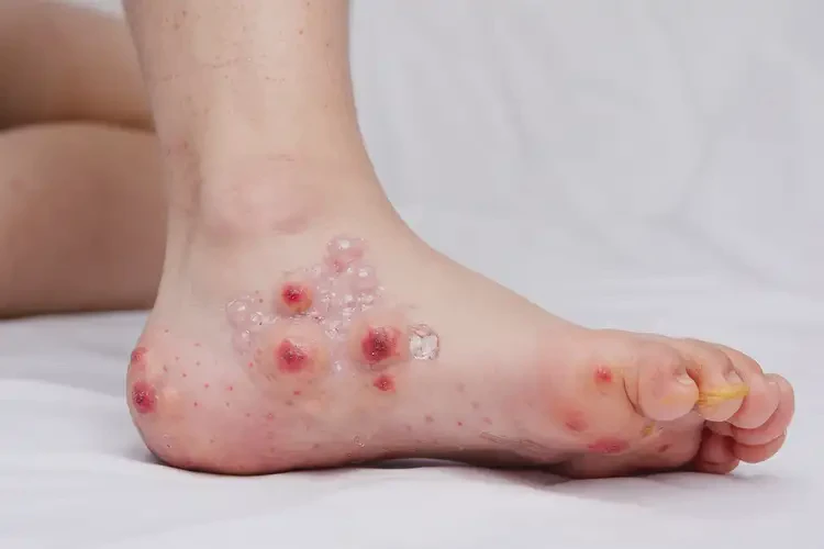 少儿脚上出湿疹可不可以彻底自愈(图3)