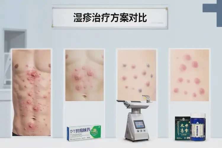 女人肚子上出湿疹不管它会自己好吗(图2)