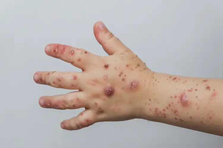 小学生手上有湿疹不管它会自己好吗(图2)