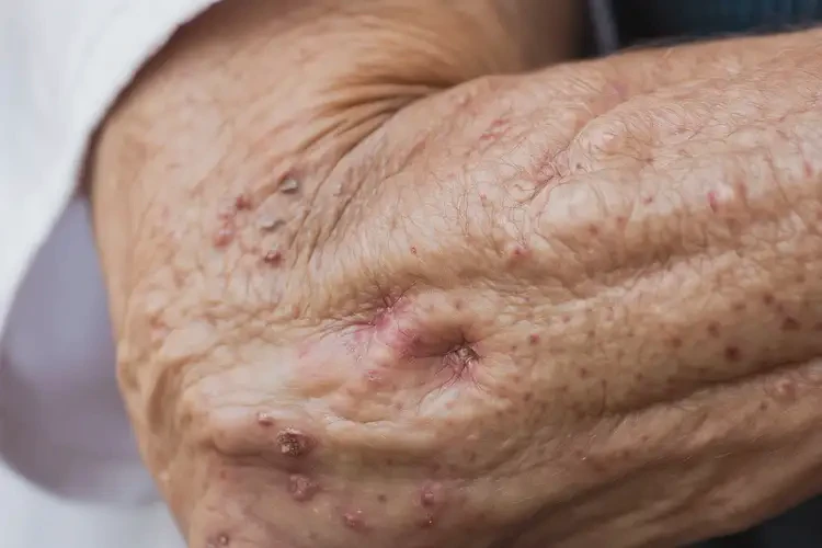 高龄老人手臂起湿疹能不能彻底自愈(图4)