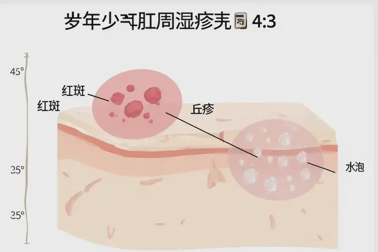 青少年肛周经常长湿疹不管它会自己痊愈吗(图4)