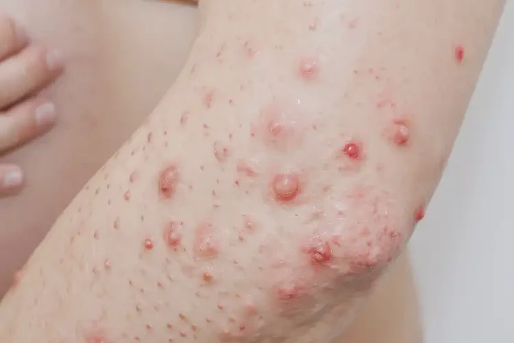 產(chǎn)婦手臂上偶爾長(zhǎng)濕疹可不可以徹底自愈(圖4)