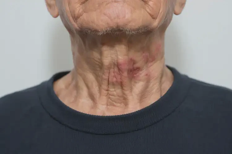 老人脖子上偶爾起濕疹能靠自己自愈嗎(圖2)