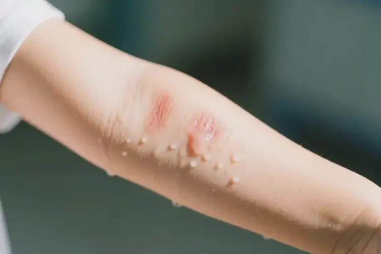 少兒手臂出濕疹可以徹底自愈嗎(圖1)