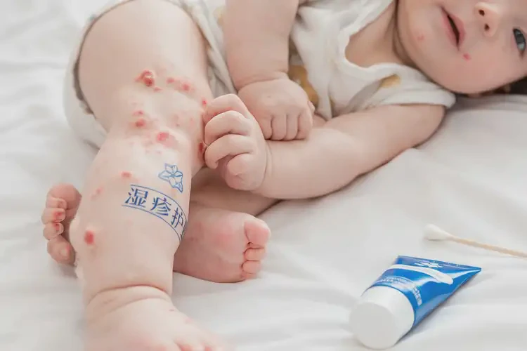 幼儿四肢起湿疹可不可以彻底自愈(图4)